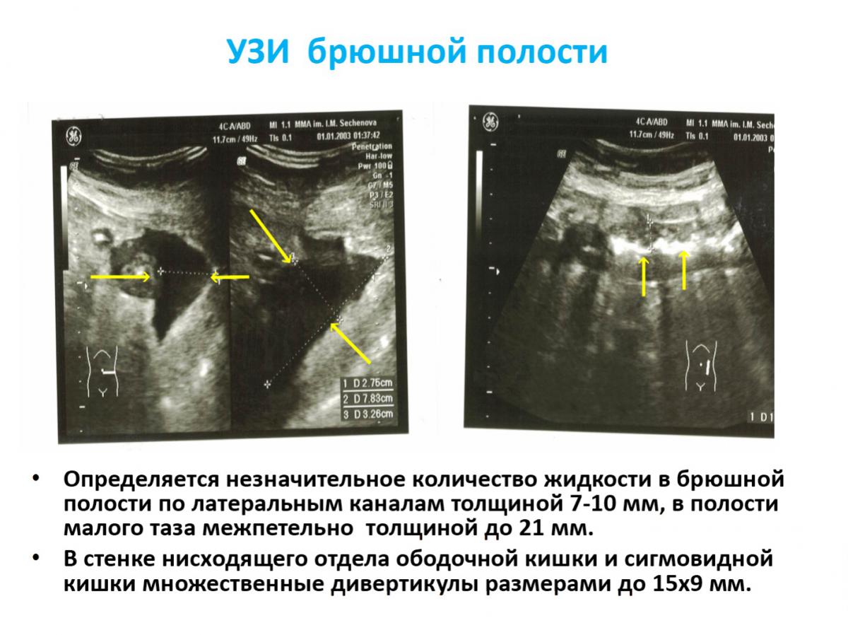 Узи Брюшной Полости Цена